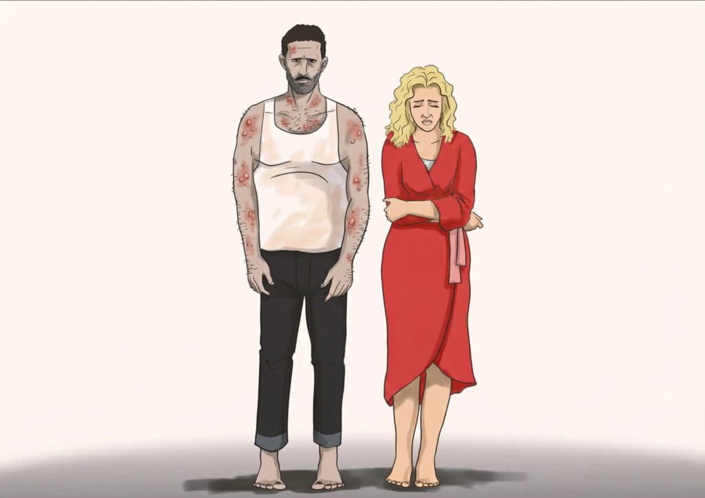herpes الهربس التناسلي